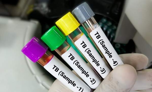 News24 | Tongue swabs: Where might these experimental TB tests eventually fit in?